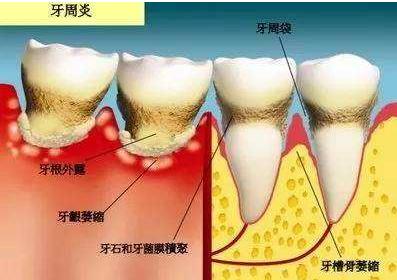 牙周炎治療